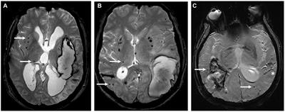 Underlying Small Vessel Disease Associated With Mixed Cerebral Microbleeds